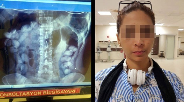Sindirim Sisteminden 78 Adet Kokain Kapsülü Çıktı